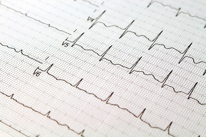 EKG paper