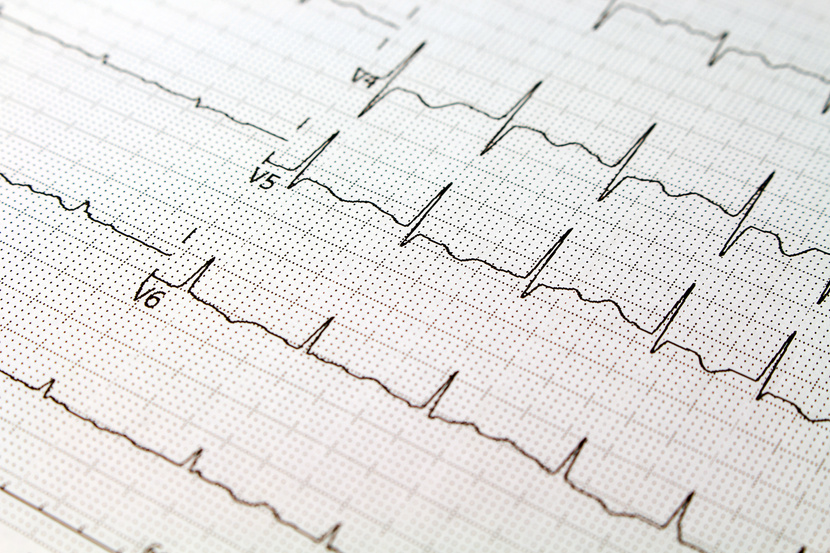 EKG paper